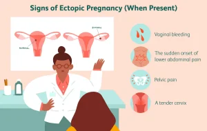 Ectopic Pregnancy