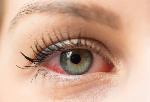 pink eye during pregnancy